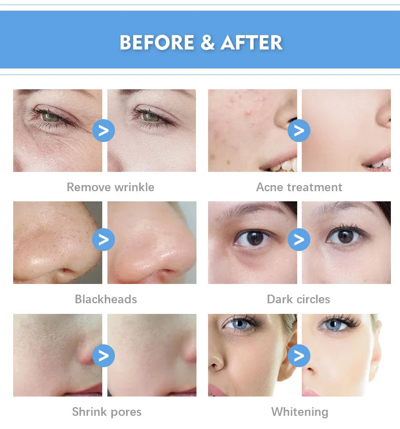 Best Smart Ice Blue Facial Treatment Machine 2025 Hydrofacial 7 In 1 Professional Portable Dermabrasion The Latest