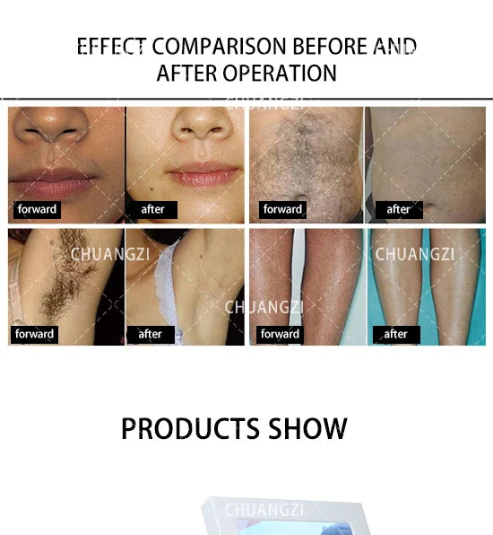 Professional Soprana Titanium Diode Laser Hair Removal Machine 3500W High Power Ice Laser Epilator 755 1064 808nm