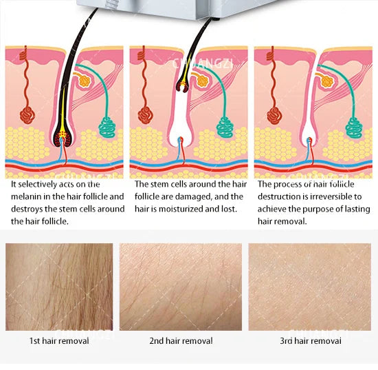 Professional Soprana Titanium Diode Laser Hair Removal Machine 3500W High Power Ice Laser Epilator 755 1064 808nm