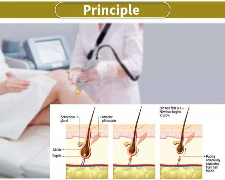 2026 SLyriclaser 1064/532nm long pulse width High quality 1064nm painless hair removal Clinic 755NM alexandrite machine