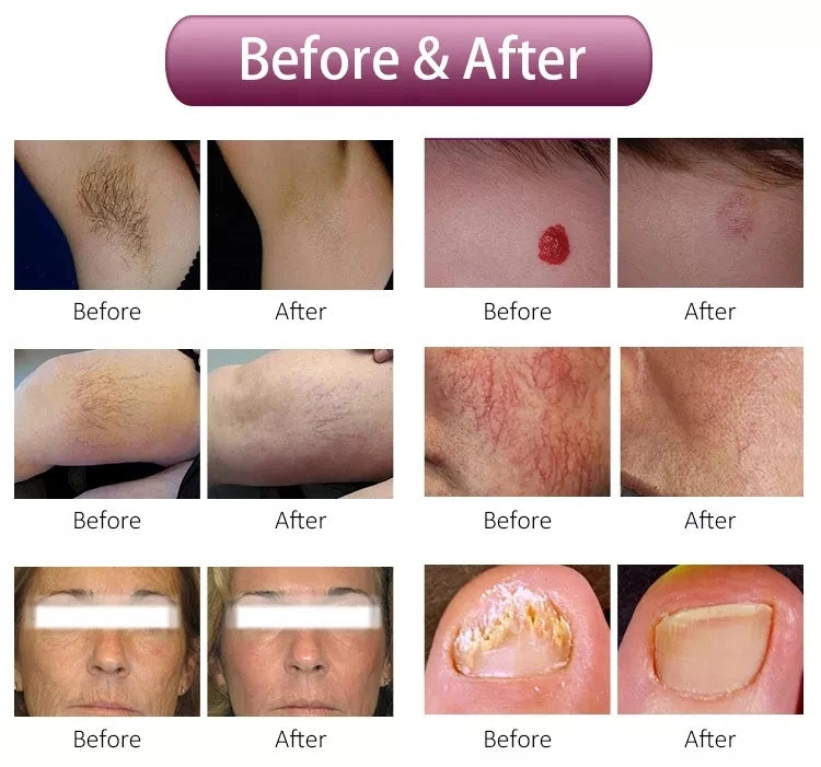 Professional Painless Hair Removal Clinic 808NM Alexandrite Machine
